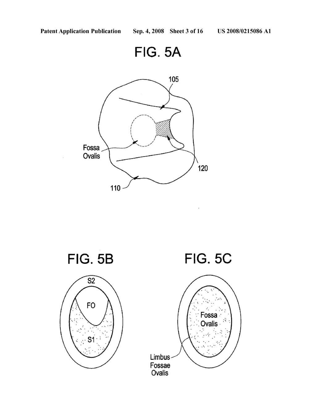SINGLE DISC INTRALUMINAL FIXATION PATENT FORAMEN OVALE CLOSURE DEVICE - diagram, schematic, and image 04