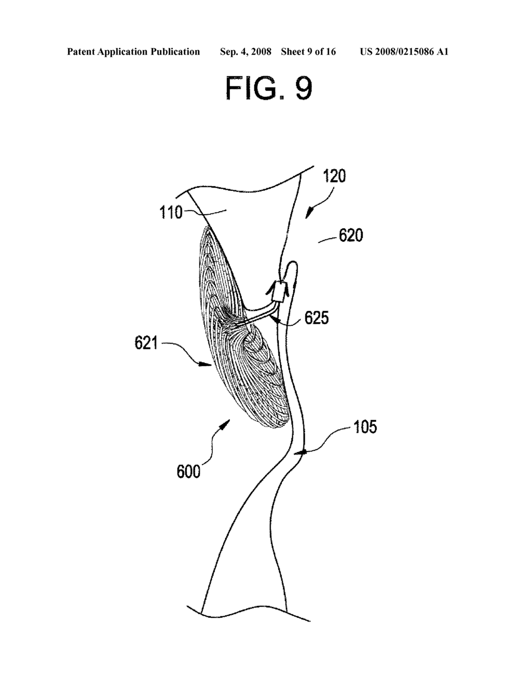 SINGLE DISC INTRALUMINAL FIXATION PATENT FORAMEN OVALE CLOSURE DEVICE - diagram, schematic, and image 10