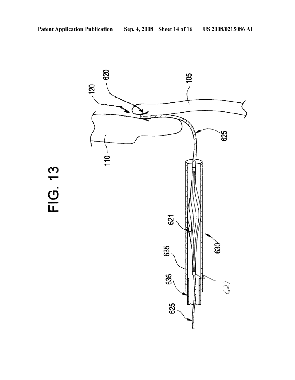 SINGLE DISC INTRALUMINAL FIXATION PATENT FORAMEN OVALE CLOSURE DEVICE - diagram, schematic, and image 15