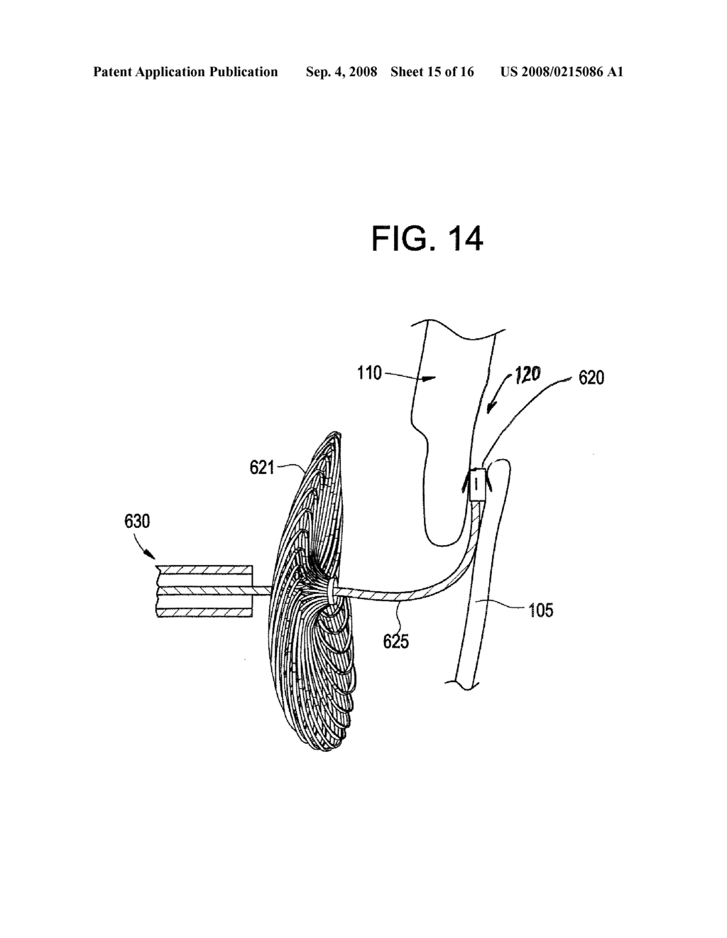 SINGLE DISC INTRALUMINAL FIXATION PATENT FORAMEN OVALE CLOSURE DEVICE - diagram, schematic, and image 16