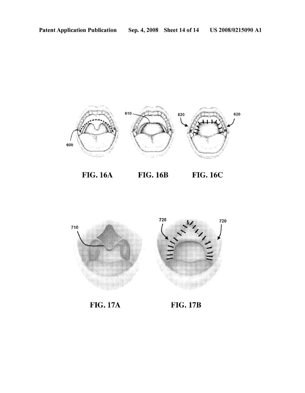 Method and System for Tissue Fastening - diagram, schematic, and image 15