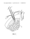 GRAFT FIXATION USING A PLUG AGAINST SUTURE diagram and image