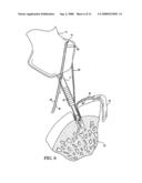 GRAFT FIXATION USING A PLUG AGAINST SUTURE diagram and image