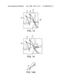 GRAFT FIXATION USING A PLUG AGAINST SUTURE diagram and image