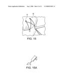 GRAFT FIXATION USING A PLUG AGAINST SUTURE diagram and image