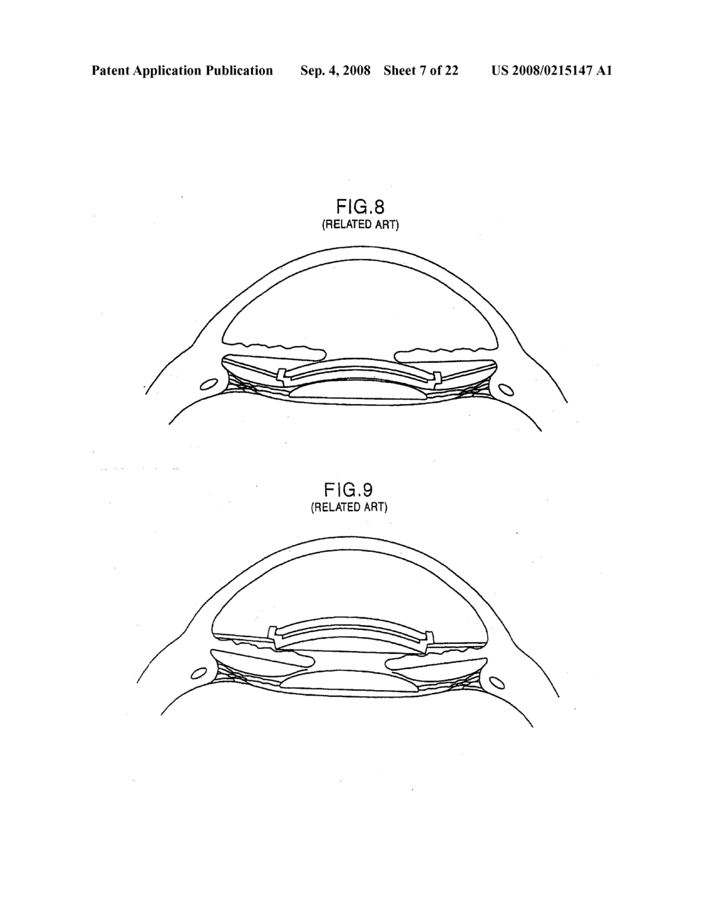 Intraocular lens system - diagram, schematic, and image 08