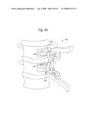 APPARATUS AND METHOD FOR PERFORMING SPINAL SURGERY diagram and image