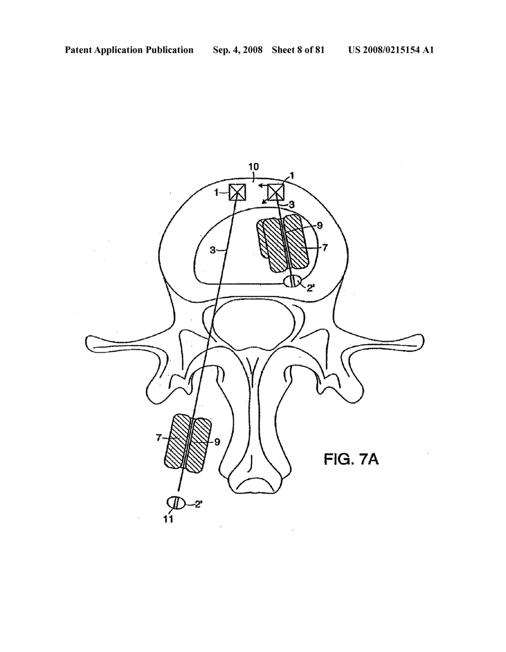 INTERVERTEBRAL DISC ANULUS IMPLANT - diagram, schematic, and image 09