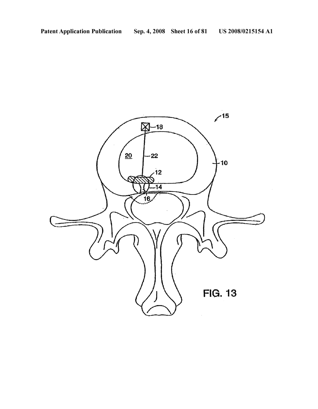 INTERVERTEBRAL DISC ANULUS IMPLANT - diagram, schematic, and image 17