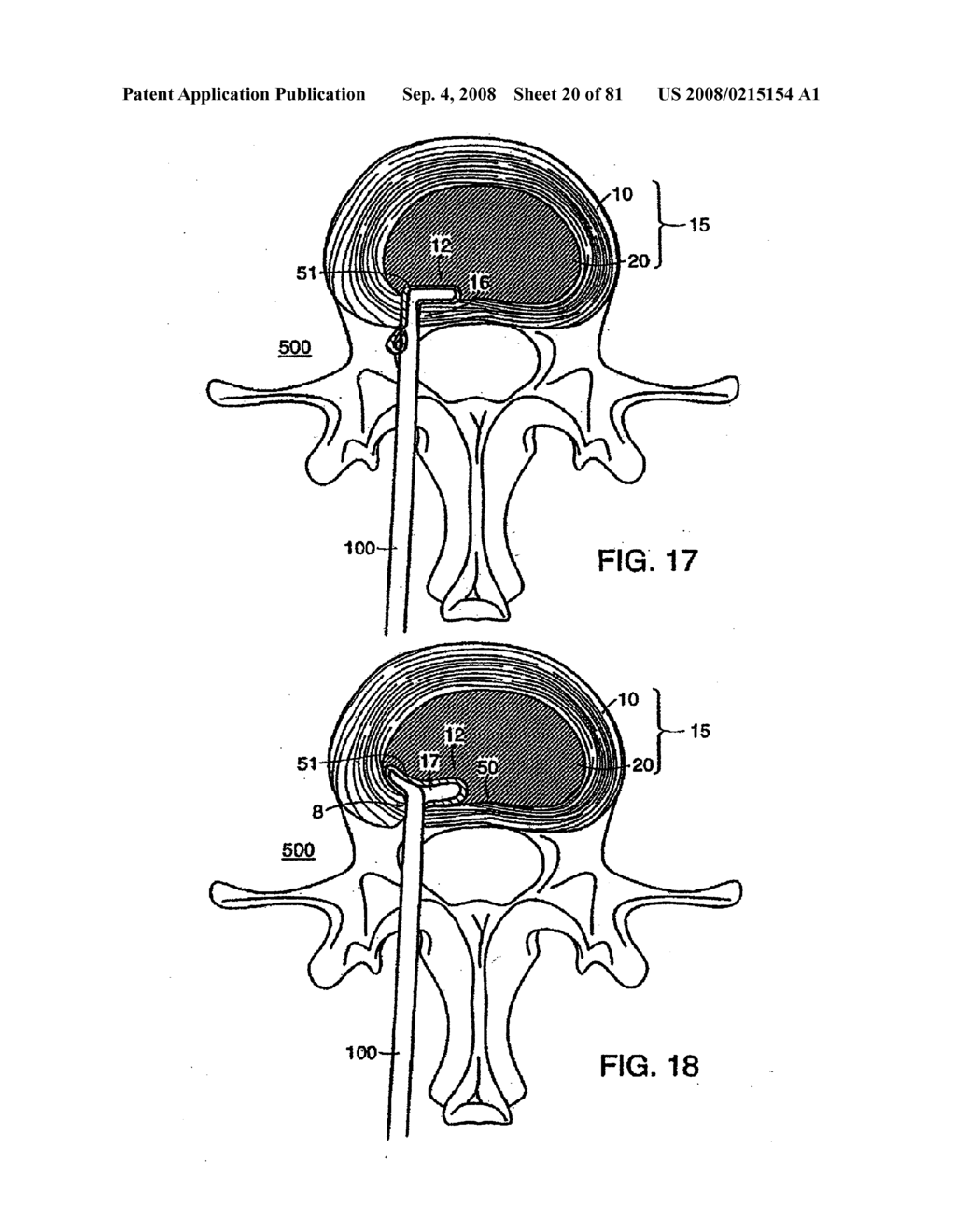 INTERVERTEBRAL DISC ANULUS IMPLANT - diagram, schematic, and image 21