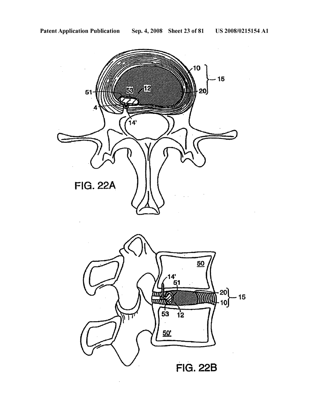 INTERVERTEBRAL DISC ANULUS IMPLANT - diagram, schematic, and image 24