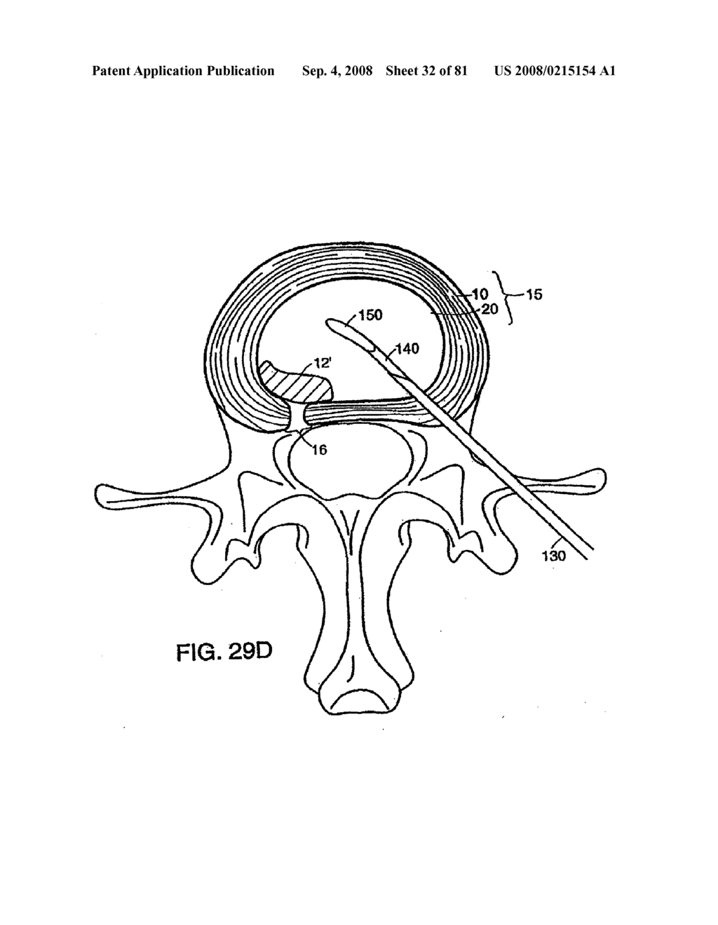 INTERVERTEBRAL DISC ANULUS IMPLANT - diagram, schematic, and image 33