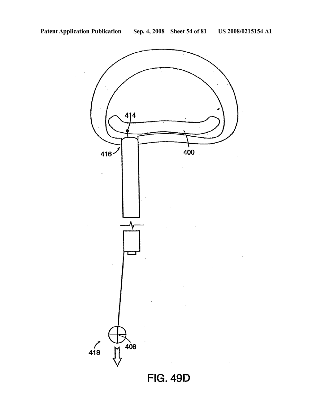 INTERVERTEBRAL DISC ANULUS IMPLANT - diagram, schematic, and image 55