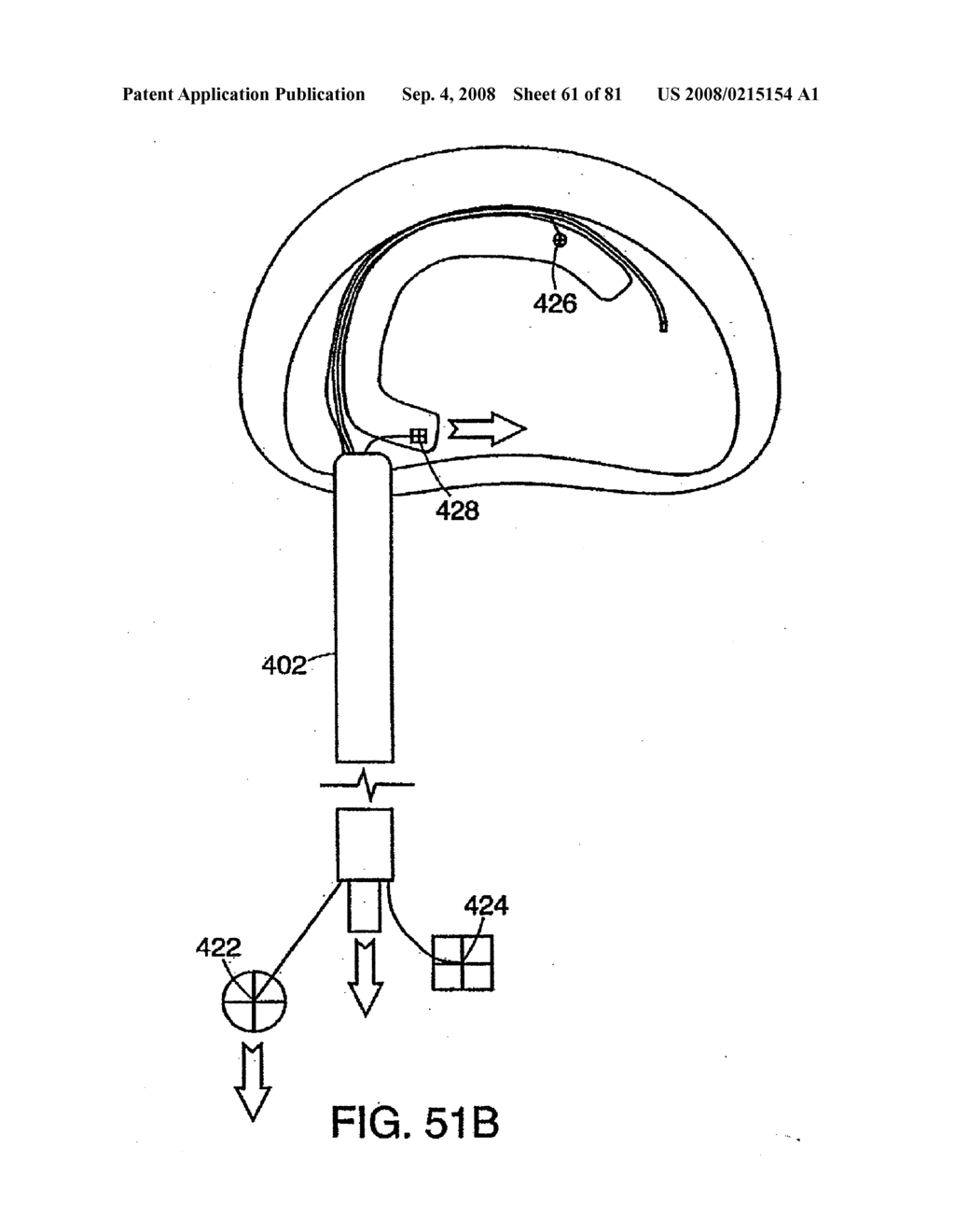 INTERVERTEBRAL DISC ANULUS IMPLANT - diagram, schematic, and image 62