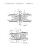 INTERVERTEBRAL PROSTHETIC DISC diagram and image