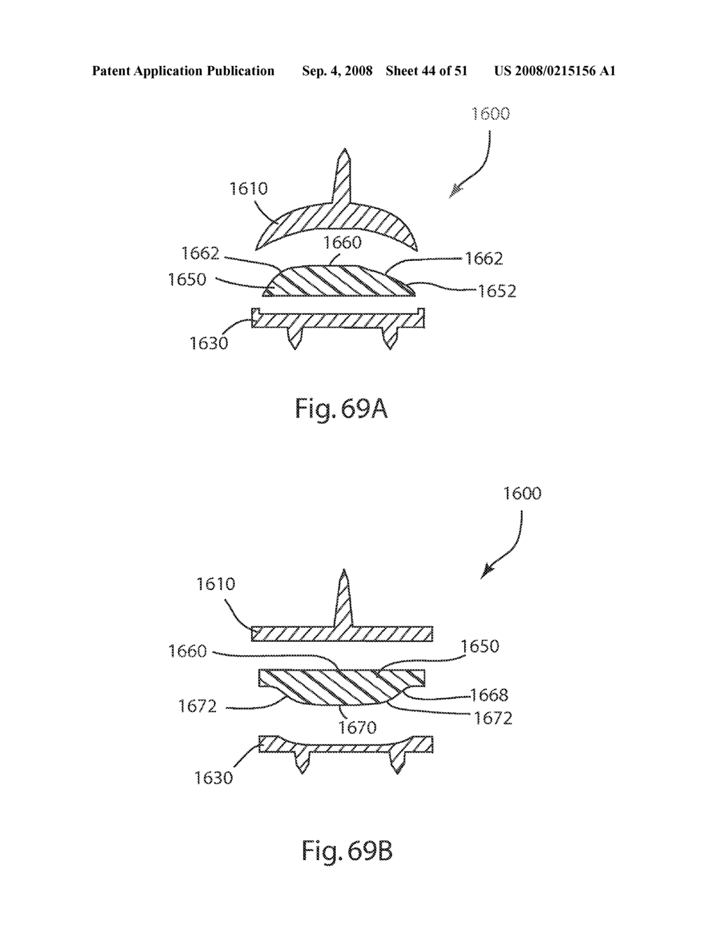 Joint Prostheses - diagram, schematic, and image 45