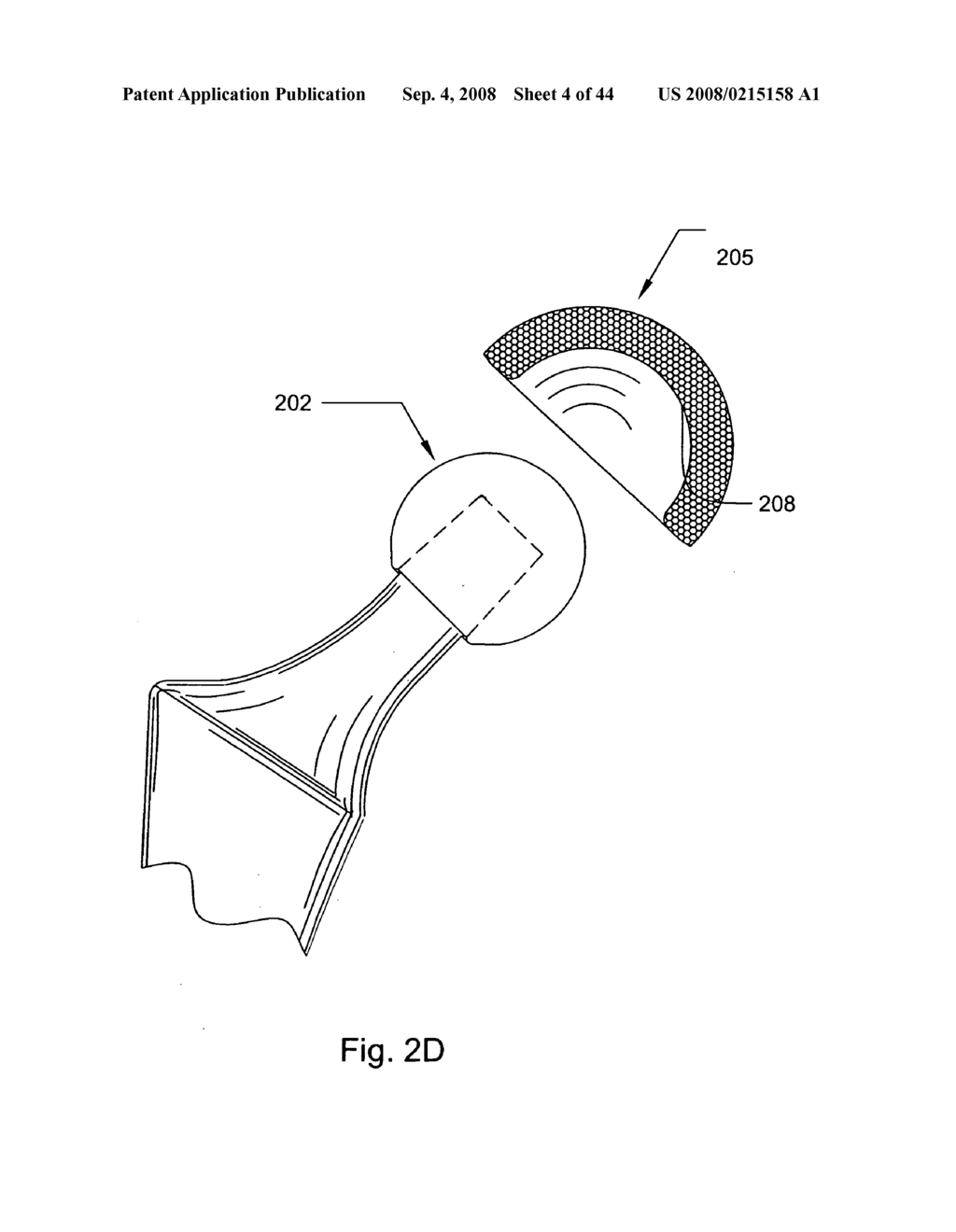 Prosthetic hip joint having polycrystalline diamond articulation surfaces and at least one solid polycrystalline diamond compact - diagram, schematic, and image 05