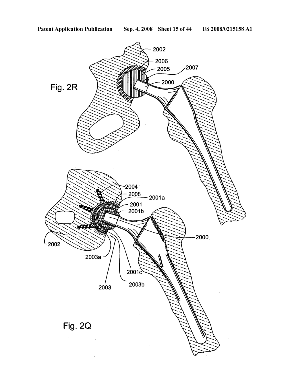 Prosthetic hip joint having polycrystalline diamond articulation surfaces and at least one solid polycrystalline diamond compact - diagram, schematic, and image 16