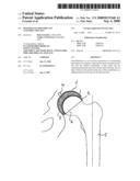 Resurfacing-Hip Implant Construction Set diagram and image