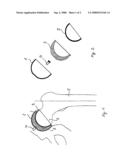 Resurfacing-Hip Implant Construction Set diagram and image