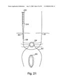 Devices for minimally invasive pelvic surgery diagram and image