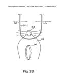 Devices for minimally invasive pelvic surgery diagram and image