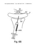 Devices for minimally invasive pelvic surgery diagram and image