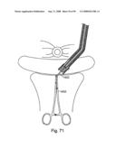 Devices for minimally invasive pelvic surgery diagram and image