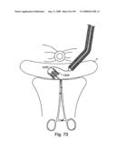 Devices for minimally invasive pelvic surgery diagram and image