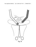 Devices for minimally invasive pelvic surgery diagram and image