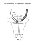 Devices for minimally invasive pelvic surgery diagram and image