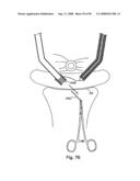 Devices for minimally invasive pelvic surgery diagram and image