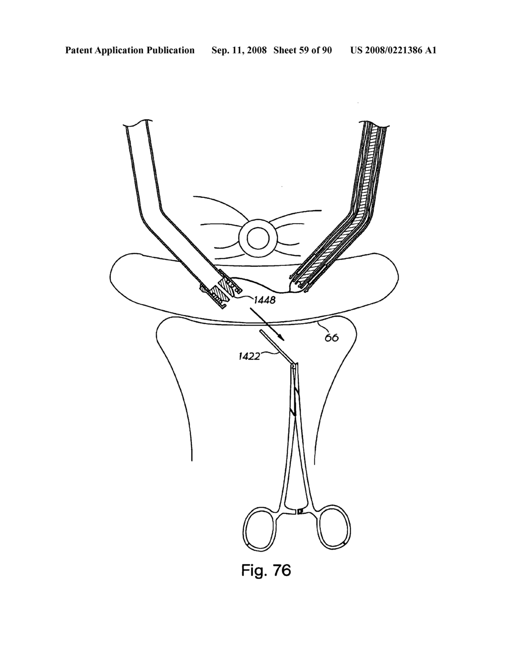 Devices for minimally invasive pelvic surgery - diagram, schematic, and image 60