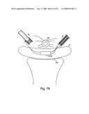 Devices for minimally invasive pelvic surgery diagram and image