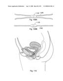 Devices for minimally invasive pelvic surgery diagram and image