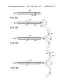 Method and Devices for Minimally Invasive Arthroscopic Procedures diagram and image