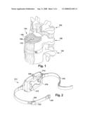 METHOD AND APPARATUS FOR REPAIR OF INTERVERTEBRAL DISCS diagram and image