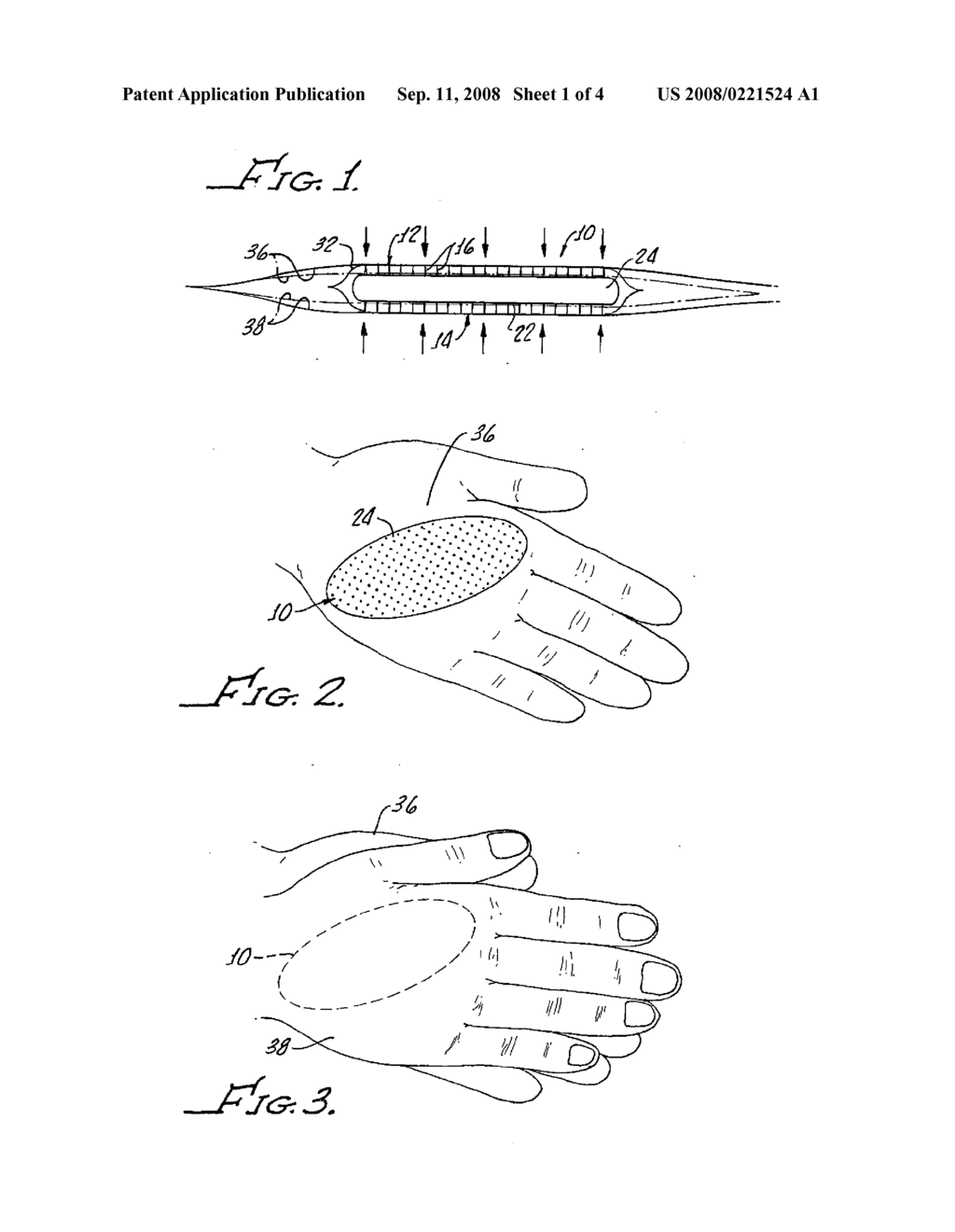 NEEDLELESS MICROPROTRUSION ELASTOPLAST SYSTEM - diagram, schematic, and image 02