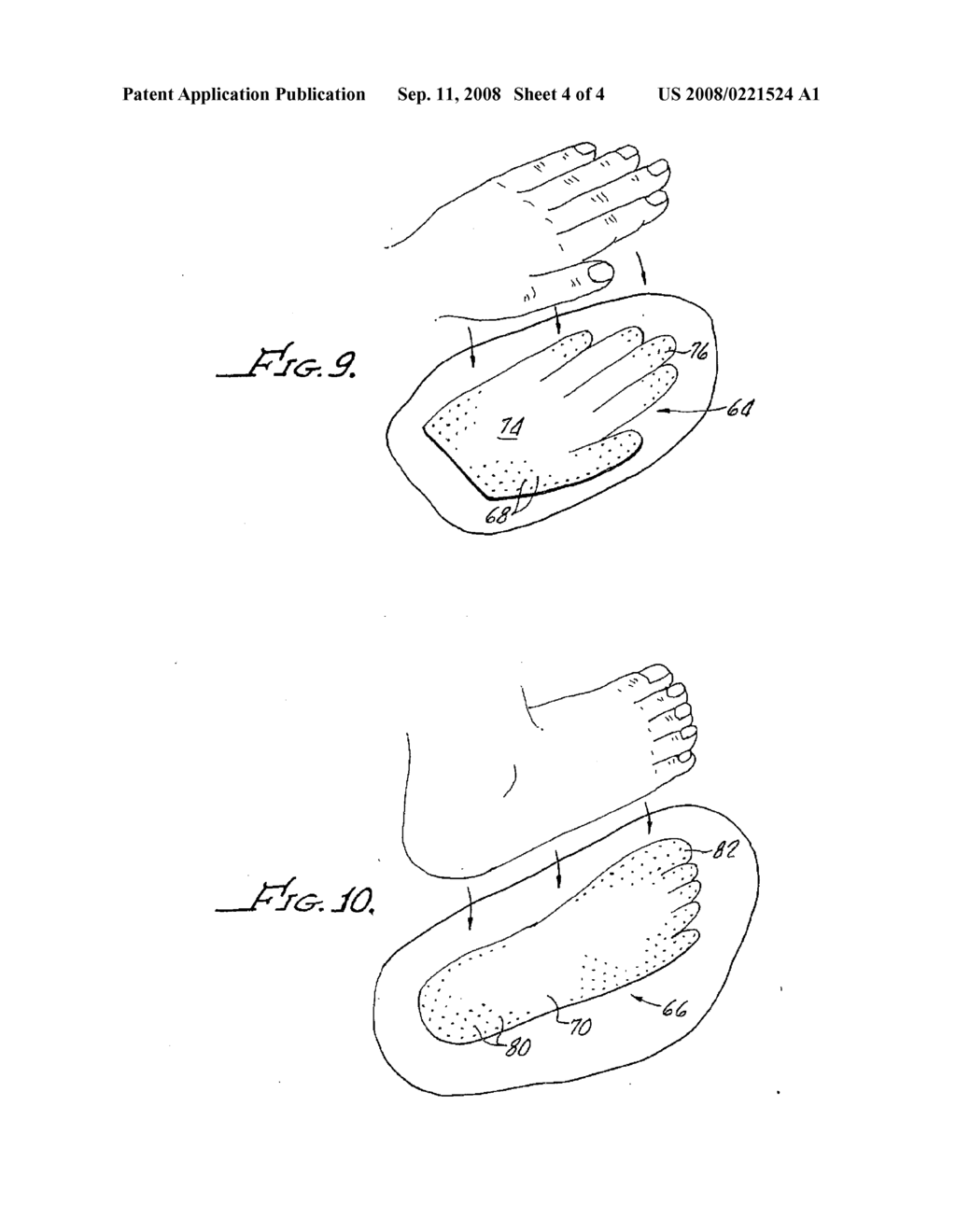 NEEDLELESS MICROPROTRUSION ELASTOPLAST SYSTEM - diagram, schematic, and image 05