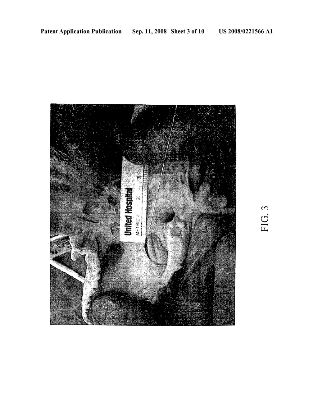 Method and apparatus for detecting and achieving closure of patent foramen ovale - diagram, schematic, and image 04