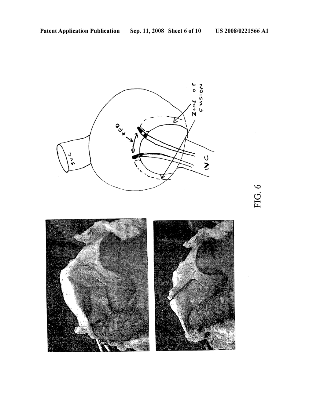 Method and apparatus for detecting and achieving closure of patent foramen ovale - diagram, schematic, and image 07