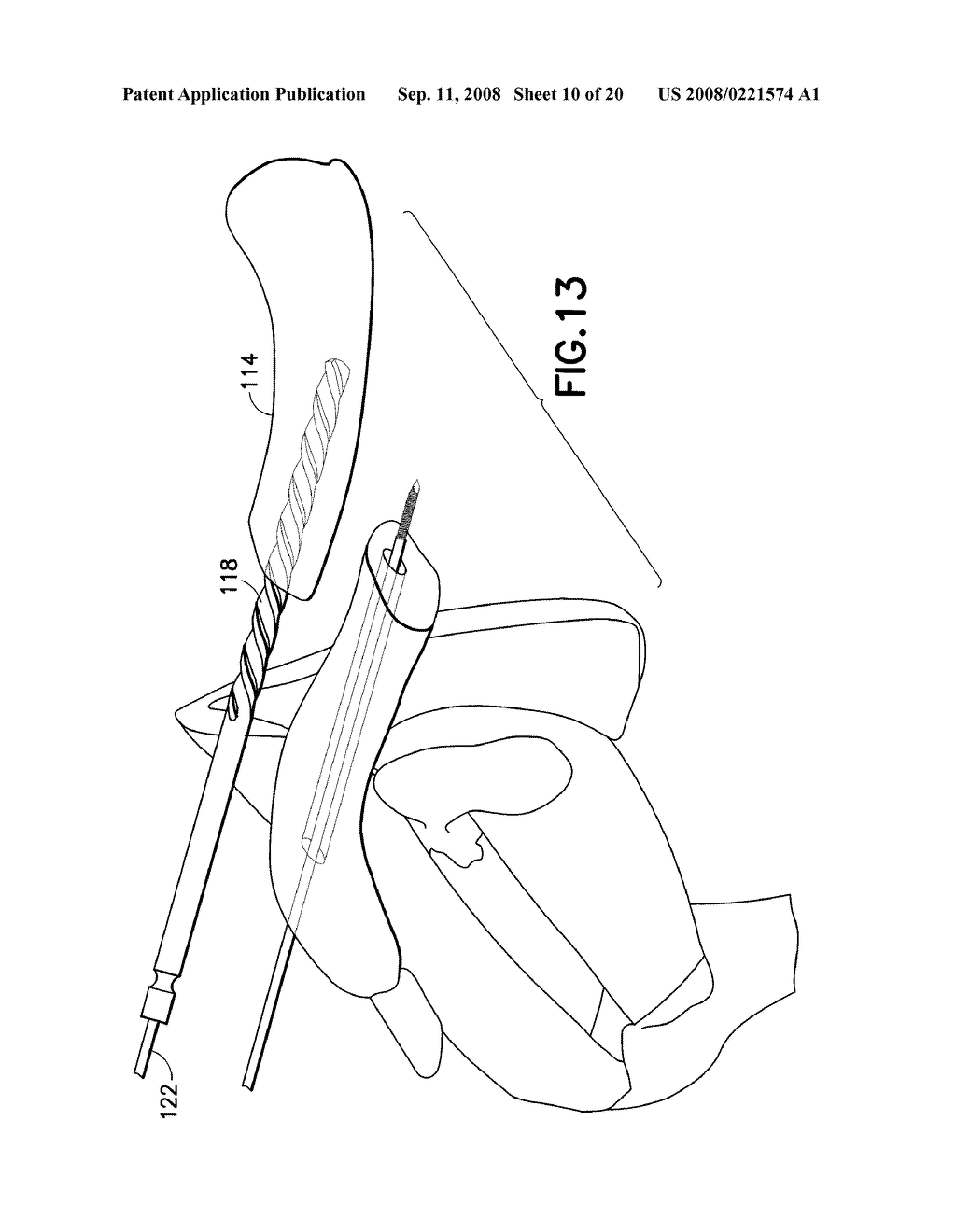 Method of Treating a Clavicle Fracture - diagram, schematic, and image 11