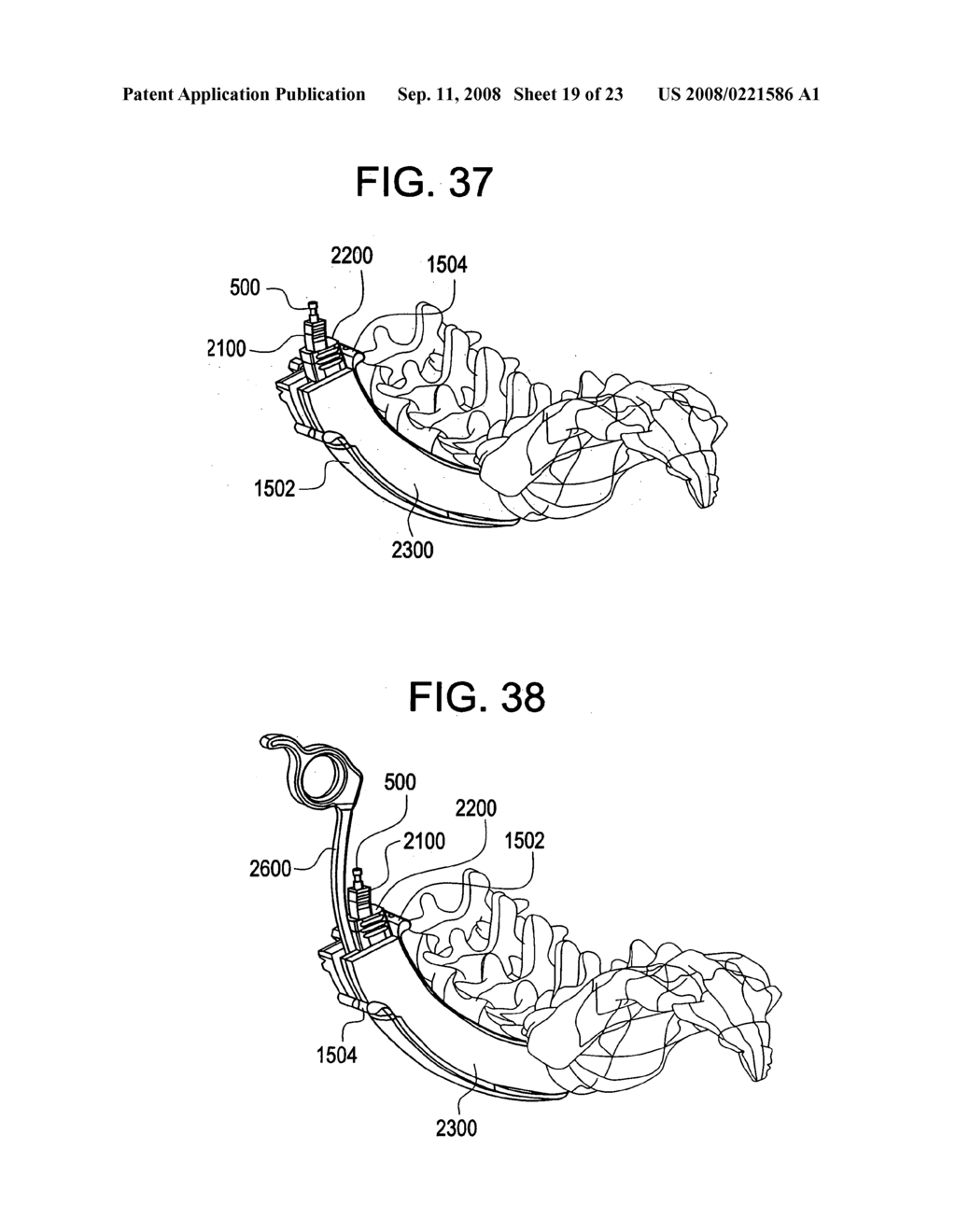 Curviliner spinal access method and device - diagram, schematic, and image 20