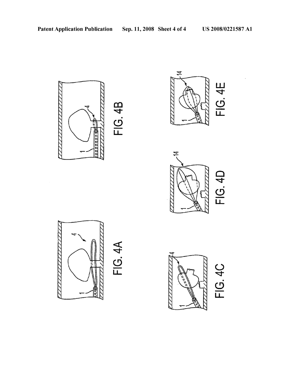 Two-stage snare-basket medical device - diagram, schematic, and image 05