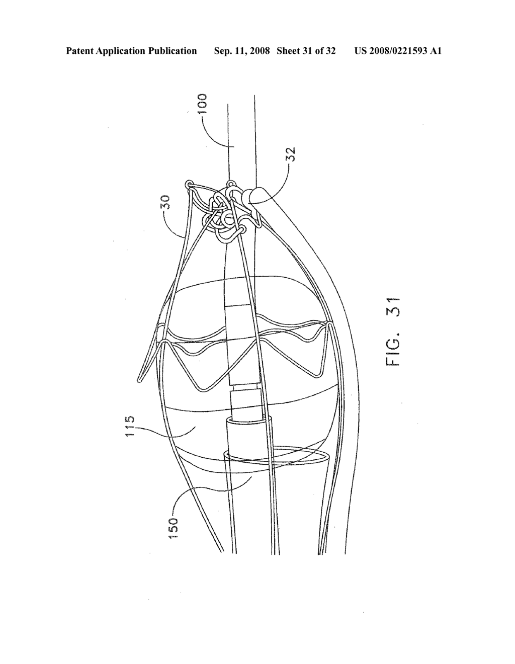 APPARATUS AND METHOD FOR THE LIGATION OF TISSUE - diagram, schematic, and image 32