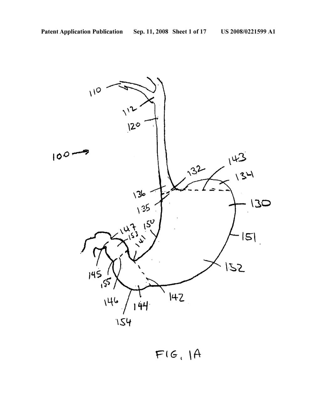 Devices, methods, and kits for gastrointestinal procedures - diagram, schematic, and image 02