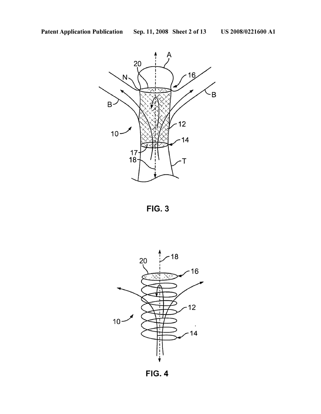 ISOLATION DEVICES FOR THE TREATMENT OF ANEURYSMS - diagram, schematic, and image 03