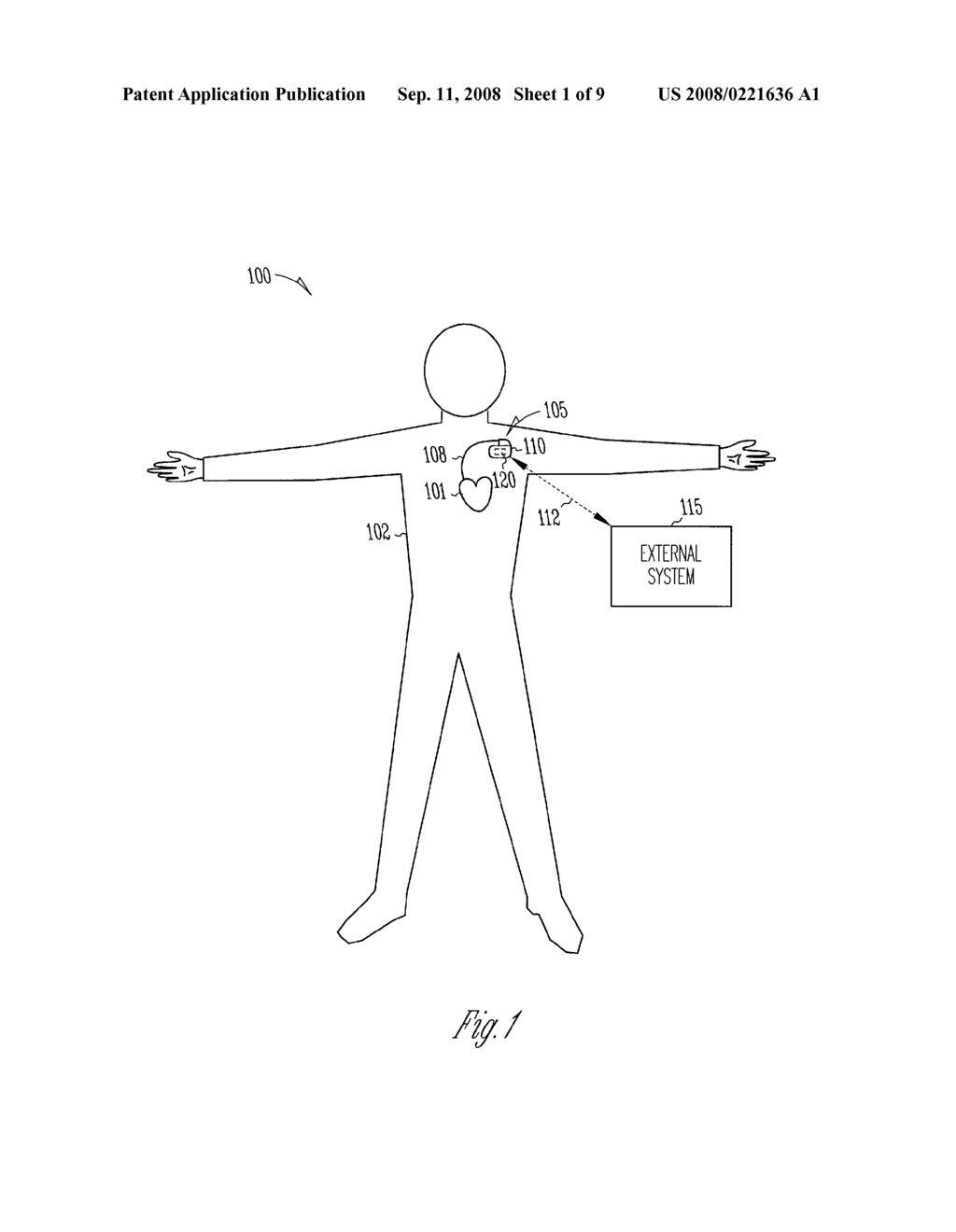 METHOD AND APPARATUS FOR CLOSED-LOOP INTERMITTENT CARDIAC STRESS AUGMENTATION PACING - diagram, schematic, and image 02