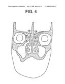 Intranasal Red Light Probe For Treating Alzheimer s Disease diagram and image