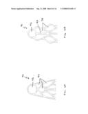 Vascular prosthesis and methods of use diagram and image